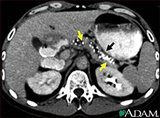CT scan showing chronic pancreatitis.