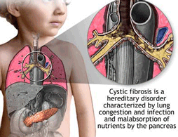 cystic fibrosis diagram
