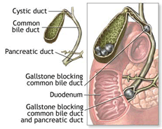 Gallstones and bile duct stones diagram.