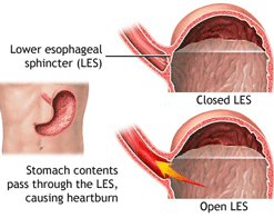 Gastroesophageal reflux disease (GERD) diagram