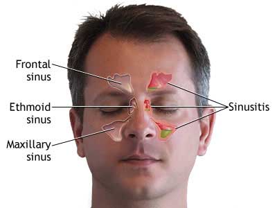 Sinusitis diagram