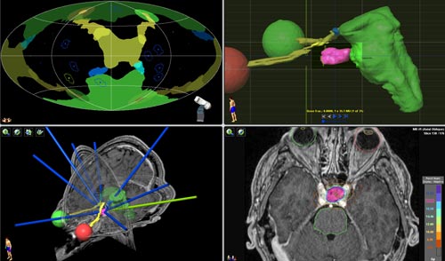 Three different views of a CT planning study of a brain tumor.