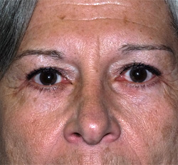 Blepharoplasty - Patient After Photo