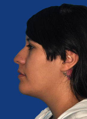 Rhinoplasty patient before photo