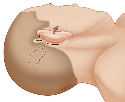image of cochlear implant incision