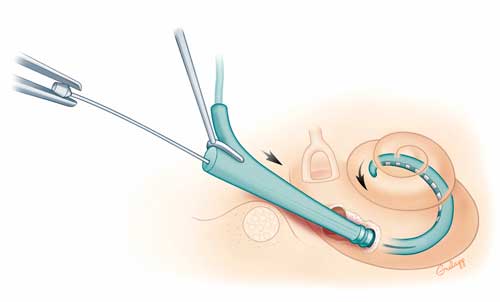 image of cochlear implant placement