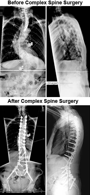 Complex spine surgery before and after photos