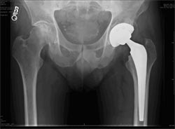 Hip replacement surgery at Virginia Mason