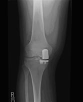 Partial knee replacement device (side view of the right knee)