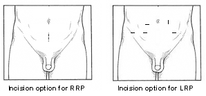 Incision options for RRP and LRP.