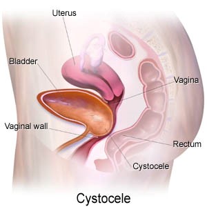 cystocele-bladder-prolapse.jpg