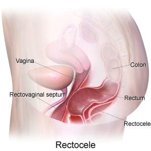 rectocele-bladder-prolapse.jpg