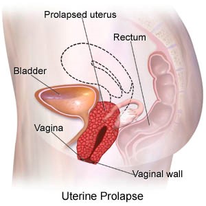 uterine-prolapse.jpg
